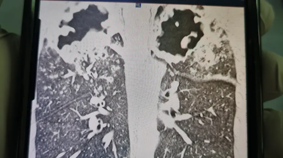 An X-Ray shows holes in Capper's lungs. Credit: GoFundMe