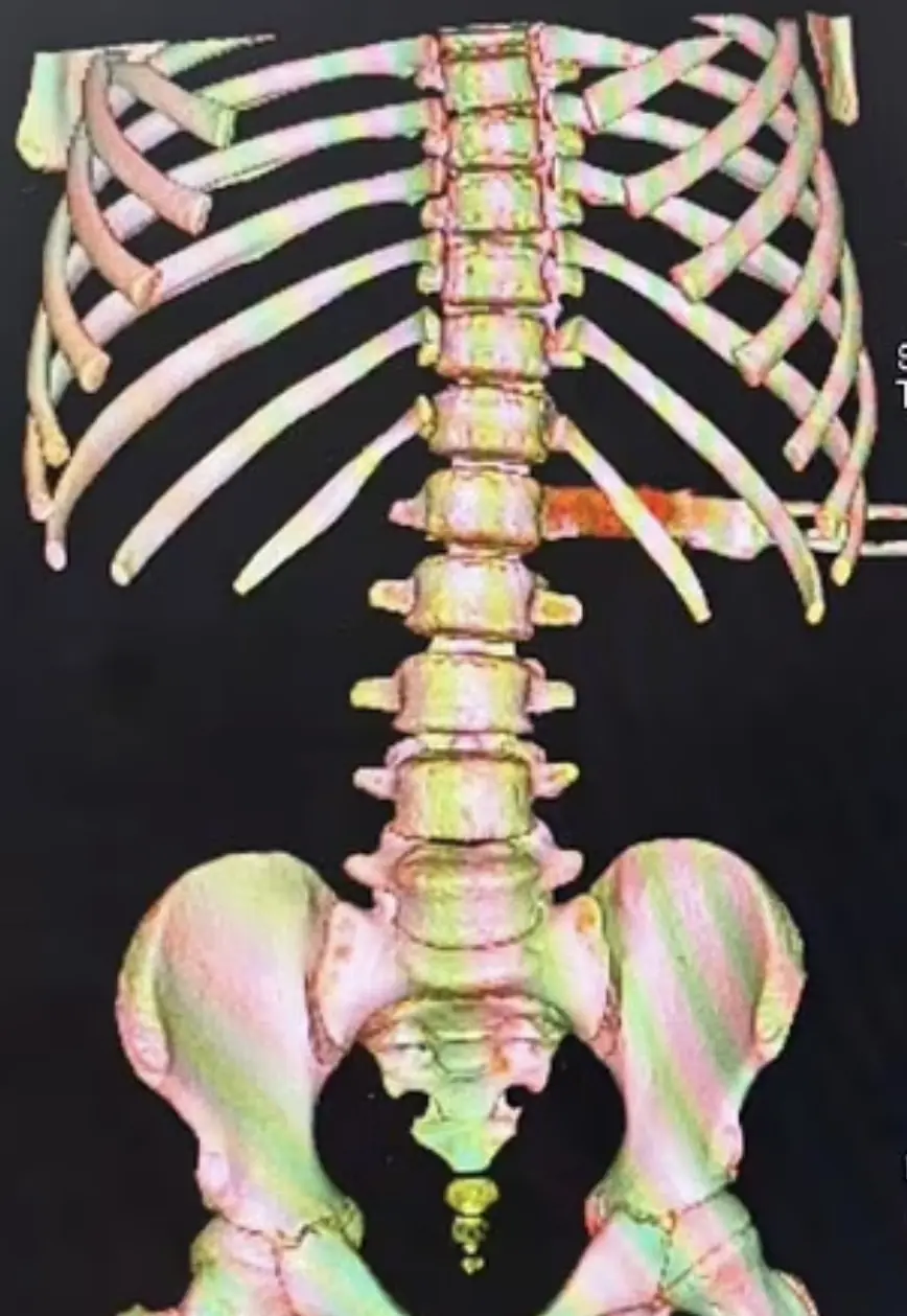 The knife was lodged in Brandon's spine. Credit: Perth Children's Hospital