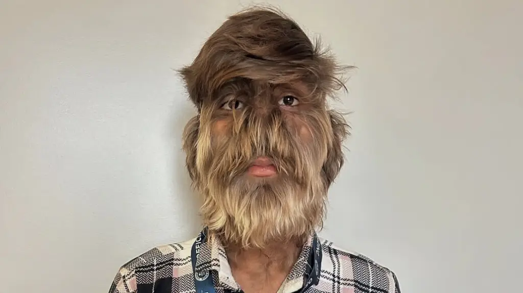 Teen earns world record for 'Hairiest Face on a Person'