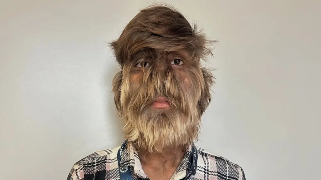 Teen earns world record for 'Hairiest Face on a Person'
