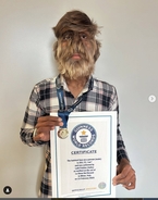 Teen earns world record for 'Hairiest Face on a Person'