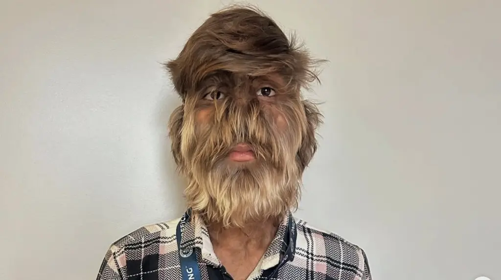Teen earns world record for 'Hairiest Face on a Person'