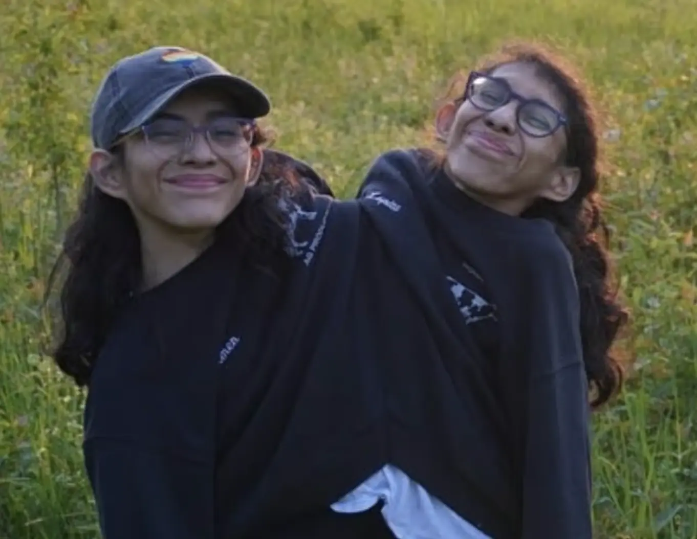 Conjoined twins reveal what would happen if one of them died