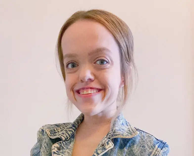 Woman who had painful surgery to grow 13 inches reveals what she looks like now