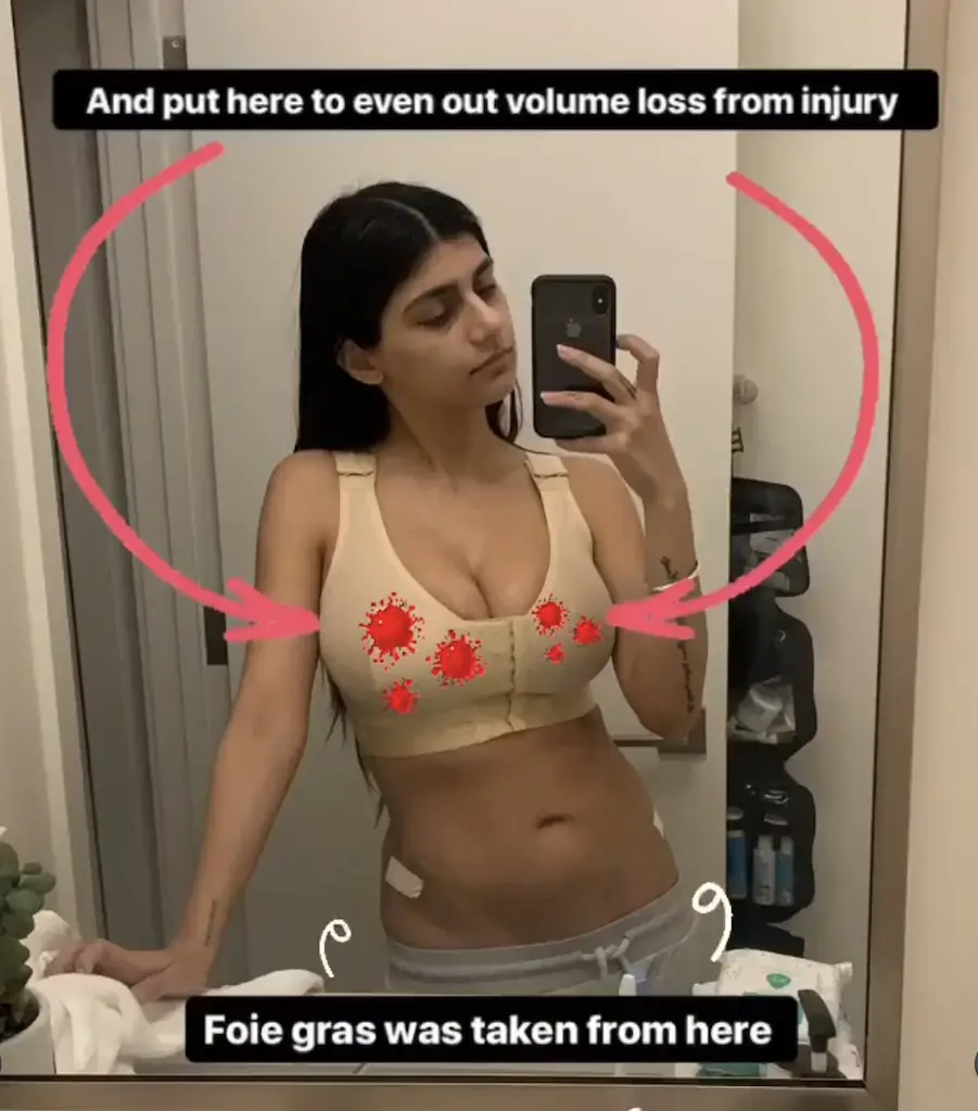 Mia Khalifa shared details of the reconstructive surgery with her followers. Credit: Mia Khalifa/Instagram