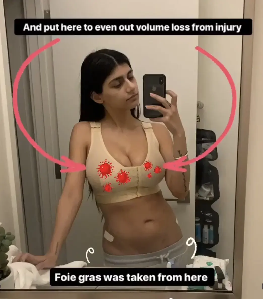 Mia Khalifa shared details of the reconstructive surgery with her followers. Credit: Mia Khalifa/Instagram