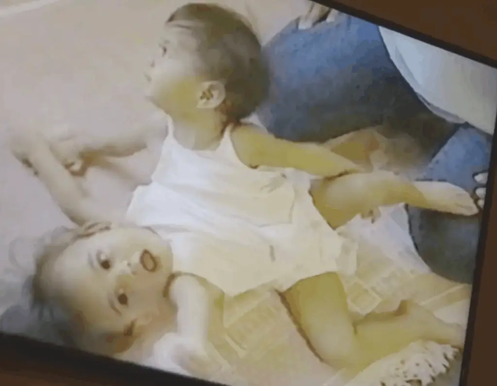 The twins chose to stay conjoined to avoid any other health complications. Credit: YouTube/Channel 4 documentaries