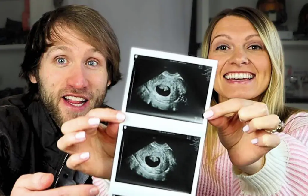 Couple have abortion after finding out their baby has Down Syndrome. Credit: Instagram