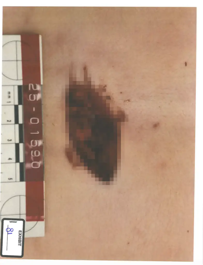 The wound was shown among other images made public. Credit: Collin County