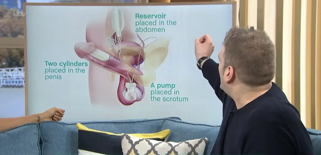Andrew Wardle's bionic penis can have erections and even has sensation. Credit: ITV/This Morning/YouTube