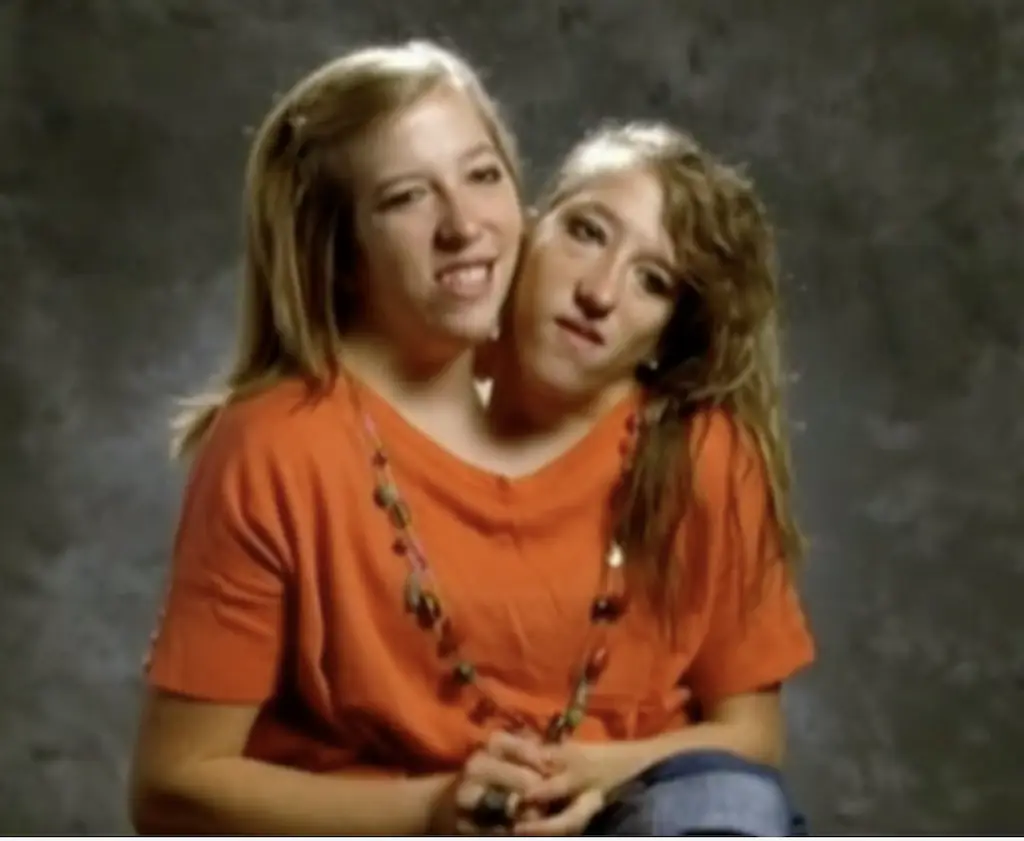 Abby and Brittany are one of the only sets of dicephalus twins. Credit: BBC
