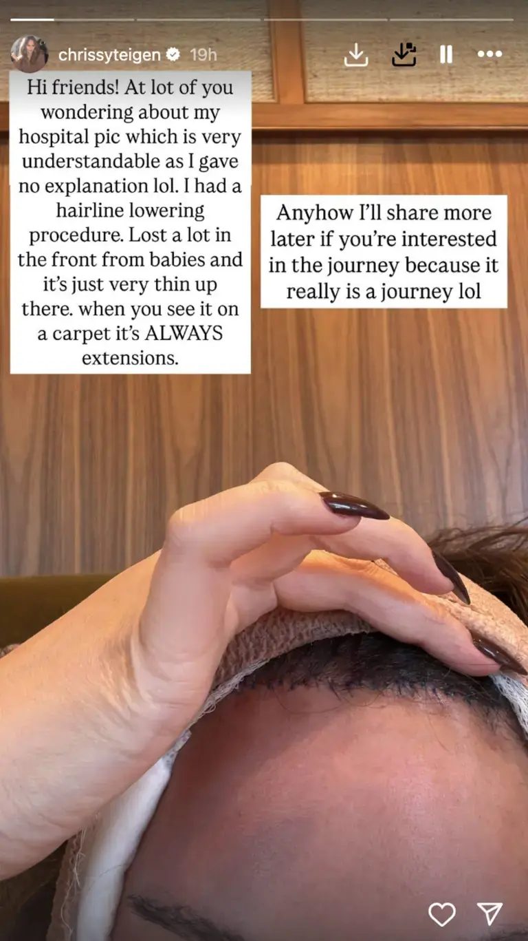 Chrissy Teigen revealed she had her hairline lowered after shocking fans with her bandaged face. Credit: Instagram / Chrissy Teigen