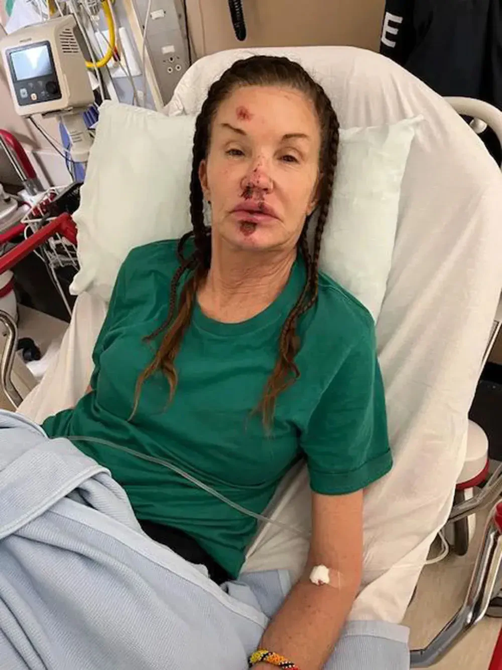 Janice Dickinson shared photos from her 2022 accident. Credit: Janice Dickinson / Instagram