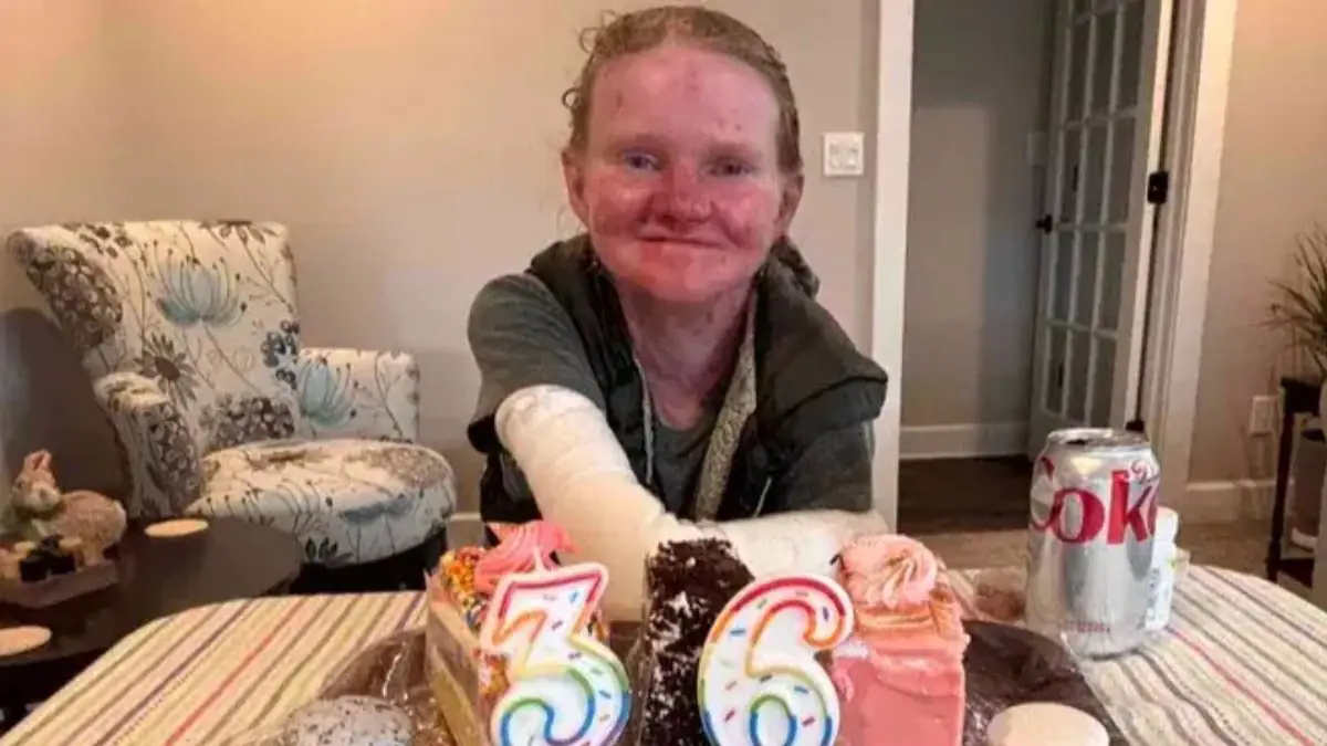 Woman with world's rarest skin condition