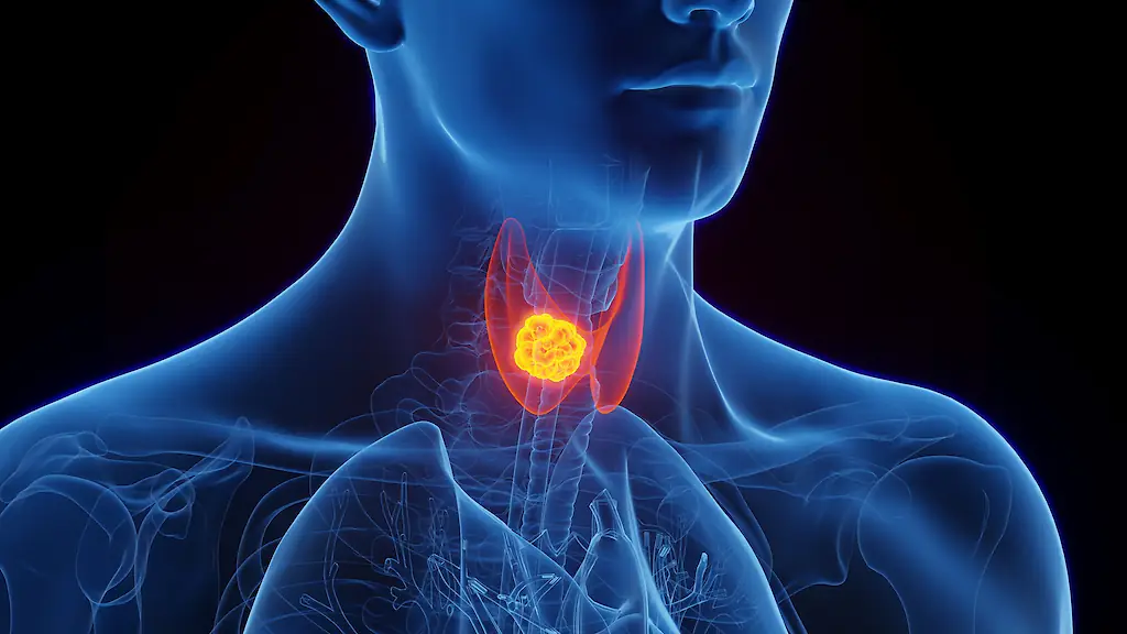 Thyroid cancer is cancer of the thyroid gland, located in the lower part of the neck. Credit:	SEBASTIAN KAULITZKI/SCIENCE PHOTO LIBRARY / Getty