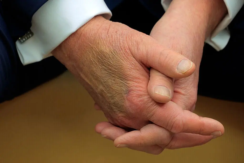 Donald Trump's hands have often appeared bruised. Credit: Chip Somodevilla / Getty Images