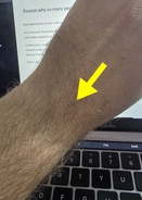 Reason why so many people seem to have the exact same freckle in the exact same place