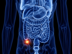 Very rare form of cancer on the rise with the symptoms often mistaken for common illness