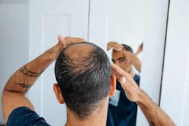 Man left with swollen head following hair transplant shows off results