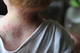 Parents of Texas girl, 6, who died of measles stand by decision to not vaccinate her