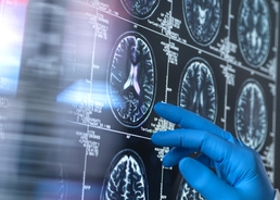 Man, 41, diagnosed with young onset Alzheimer's disease shares the early symptoms he experienced
