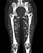 Doctor shares horrifying scan showing patient's legs after eating undercooked pork