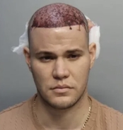 Bleeding man arrested after refusing to leave plane after hair transplant