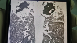 Man, 33, left 'slowly dying' with damaged lungs after making one huge mistake at friend's house