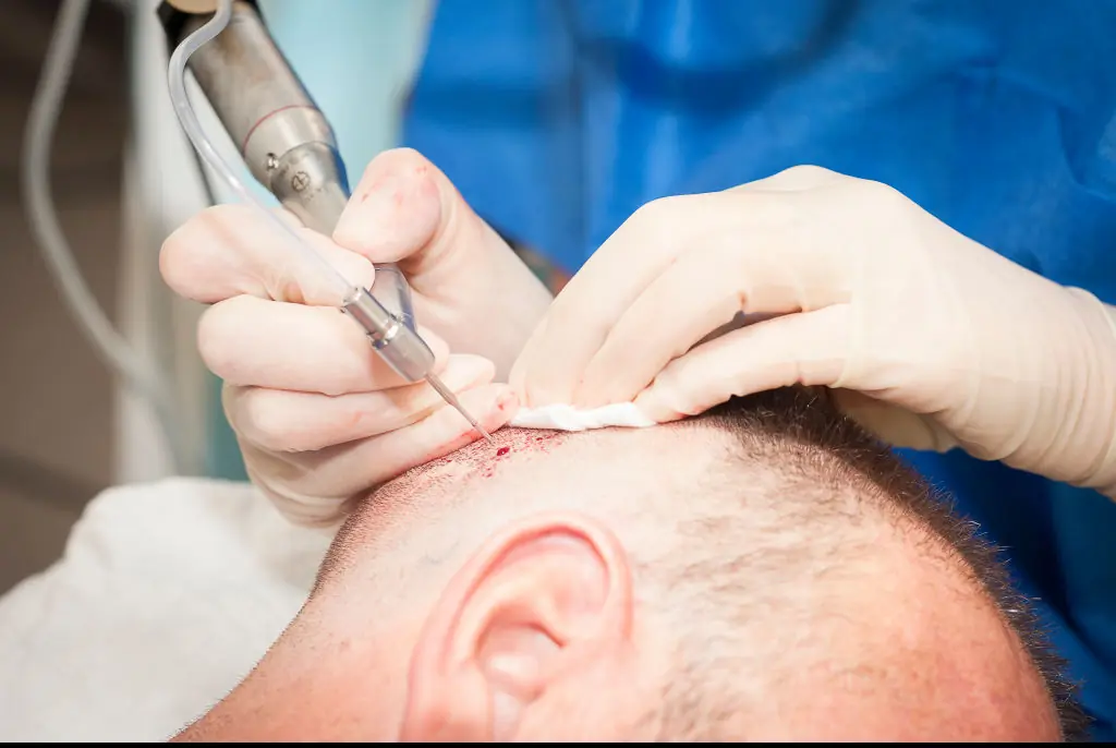 Rather than going for the traditional, safe, hair transplant. he opted for gold chains instead. Credit: BSIP/Universal Images Group via Getty Images