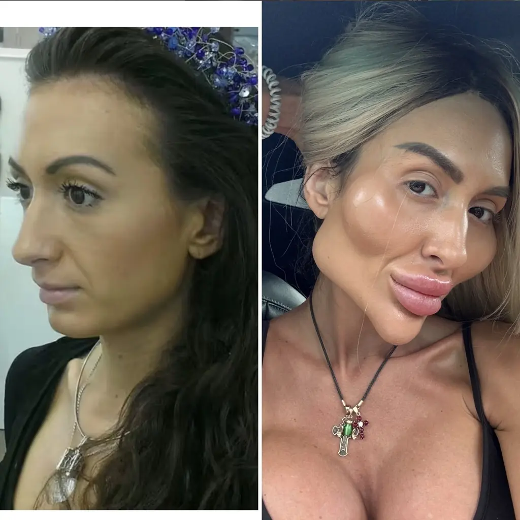 Anastasia shared a snap without any fillers at age 26, and another of her at 35, after her transformation. Credit: justqueen88/Instagram
