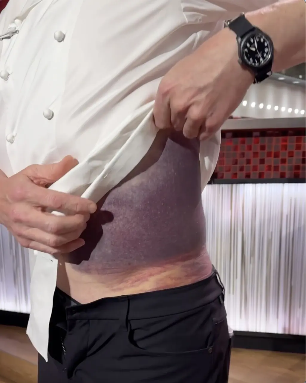 He revealed the terrifying bruising he'd been left with. Credit: Gordon Ramsay/Instagram