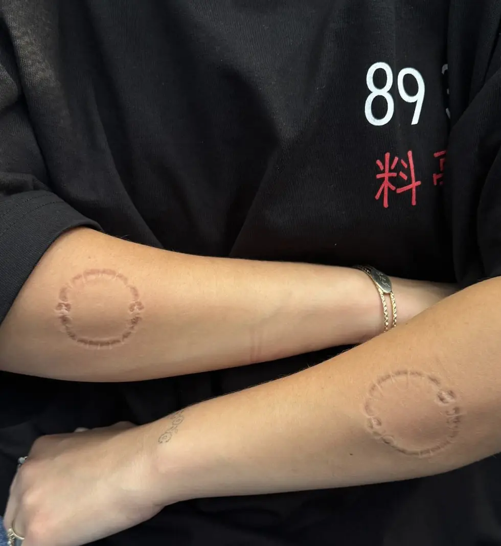 The bite marks left fans concerned. Credit: Billie Eilish/Instagram