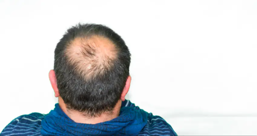 Scientists have just found a cure for baldness