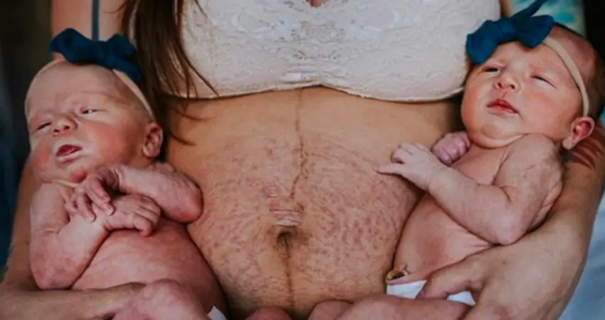 Mother shares raw photos of stretch marks