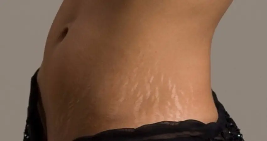 Woman turns stretch marks into works of art using glitter