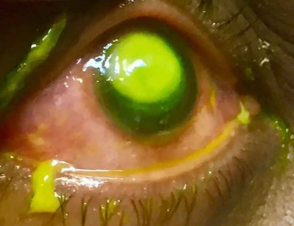 cultured pseudomonas ulcer