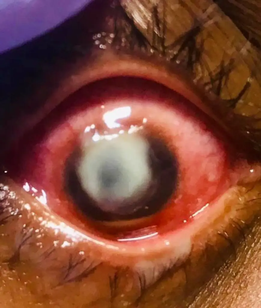 cultured pseudomonas ulcer