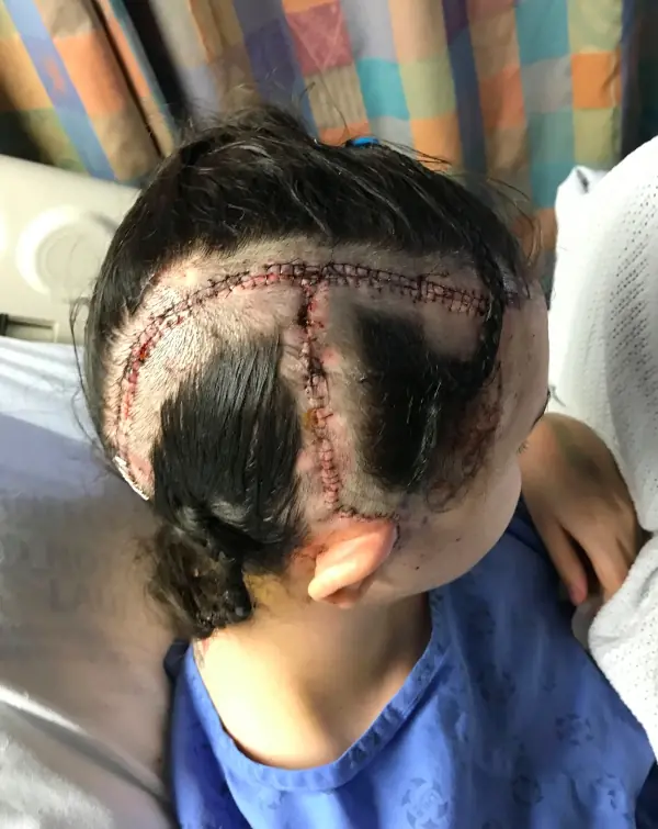 A woman with stitches in her skull. 