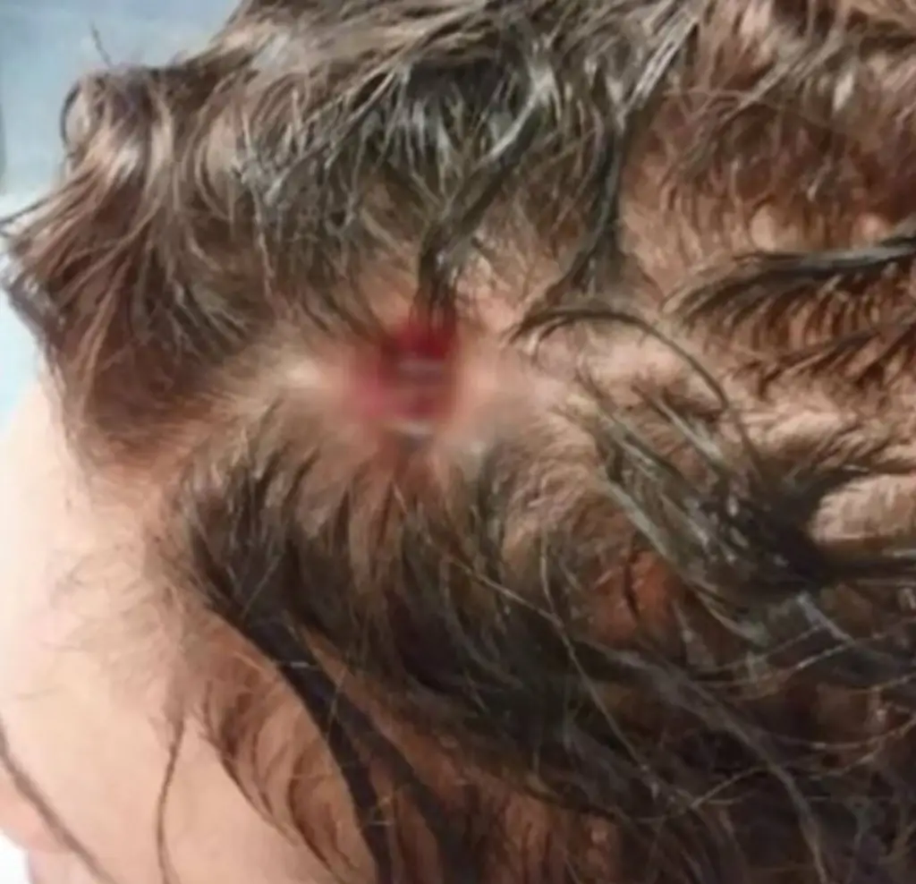 A wound in a man's head. 