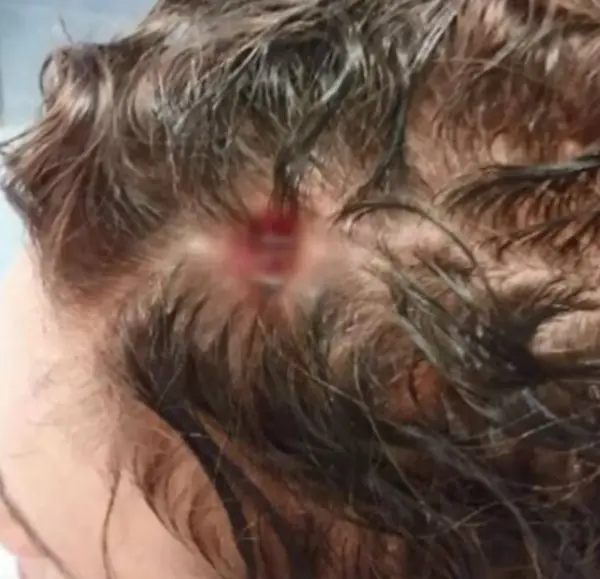 A wound in a man's head. 