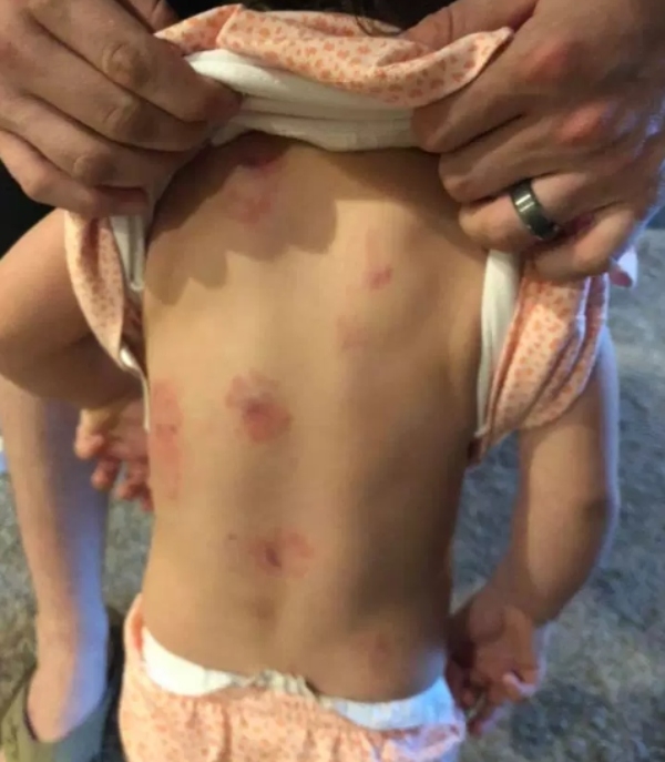 A parent showing bite marks on their child's back.