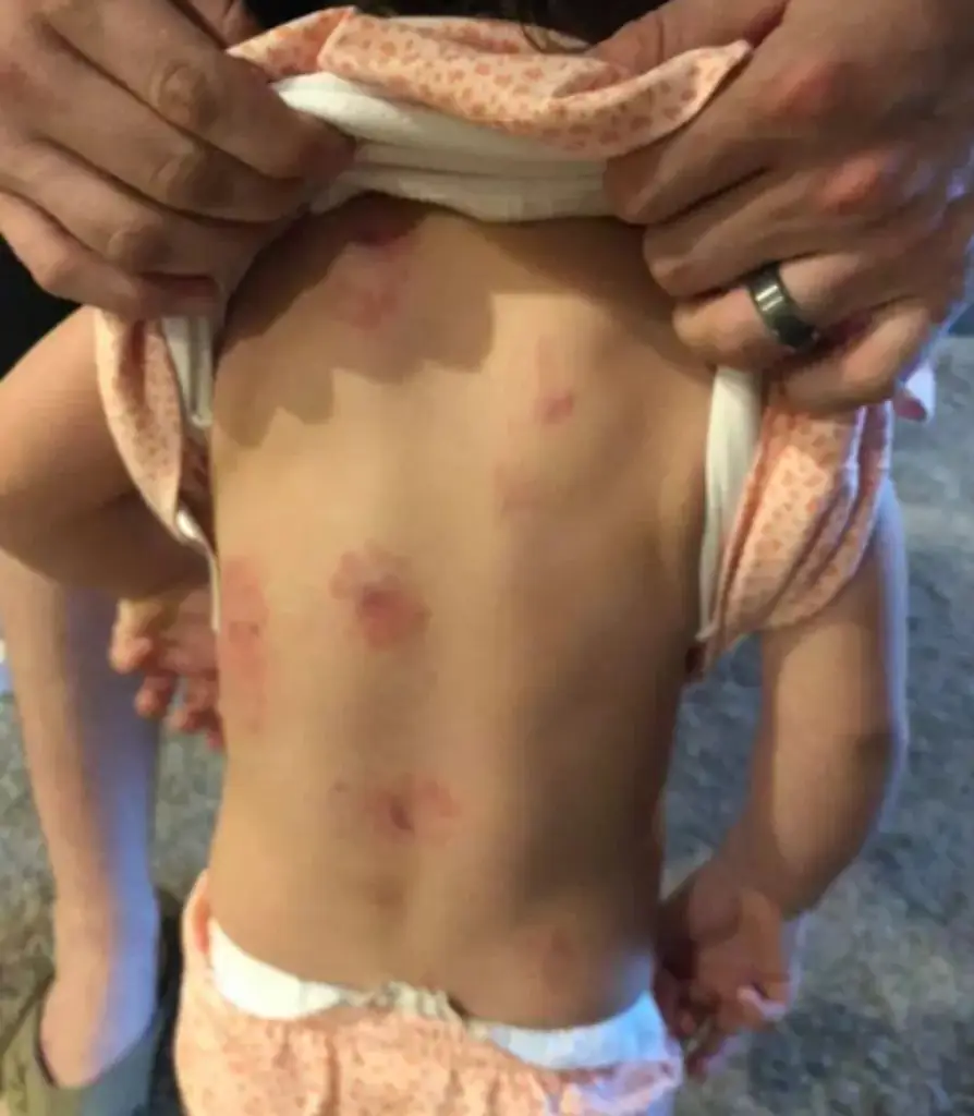A parent showing bite marks on their child's back.