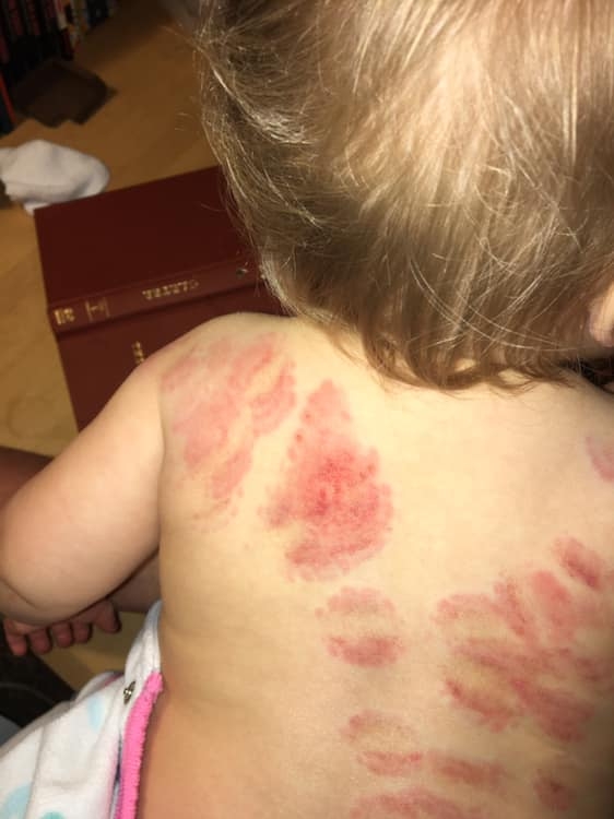 bite marks