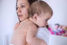 Mother and baby with measles