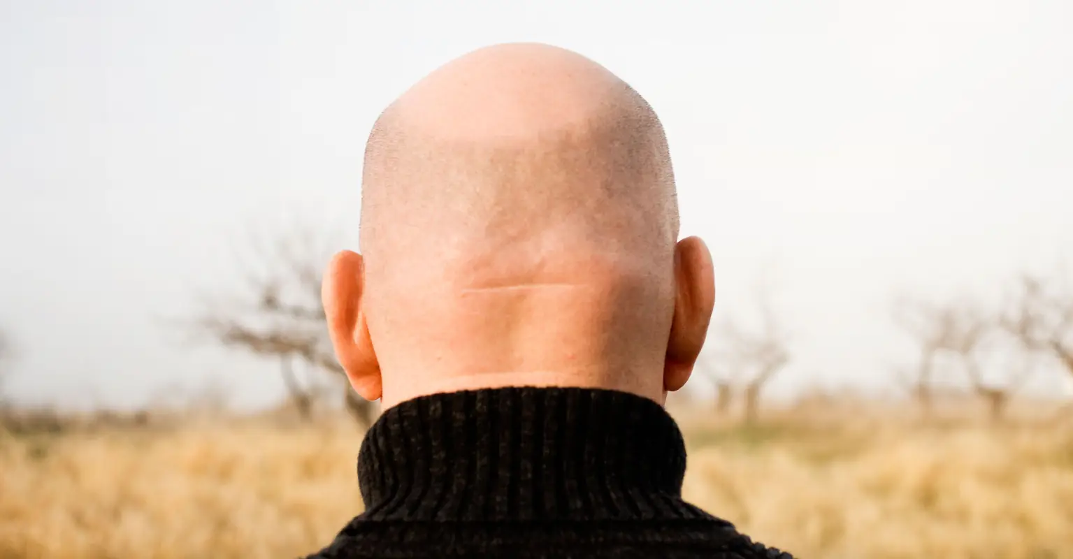 Calling men 'bald' is sexist harassment, judges rule