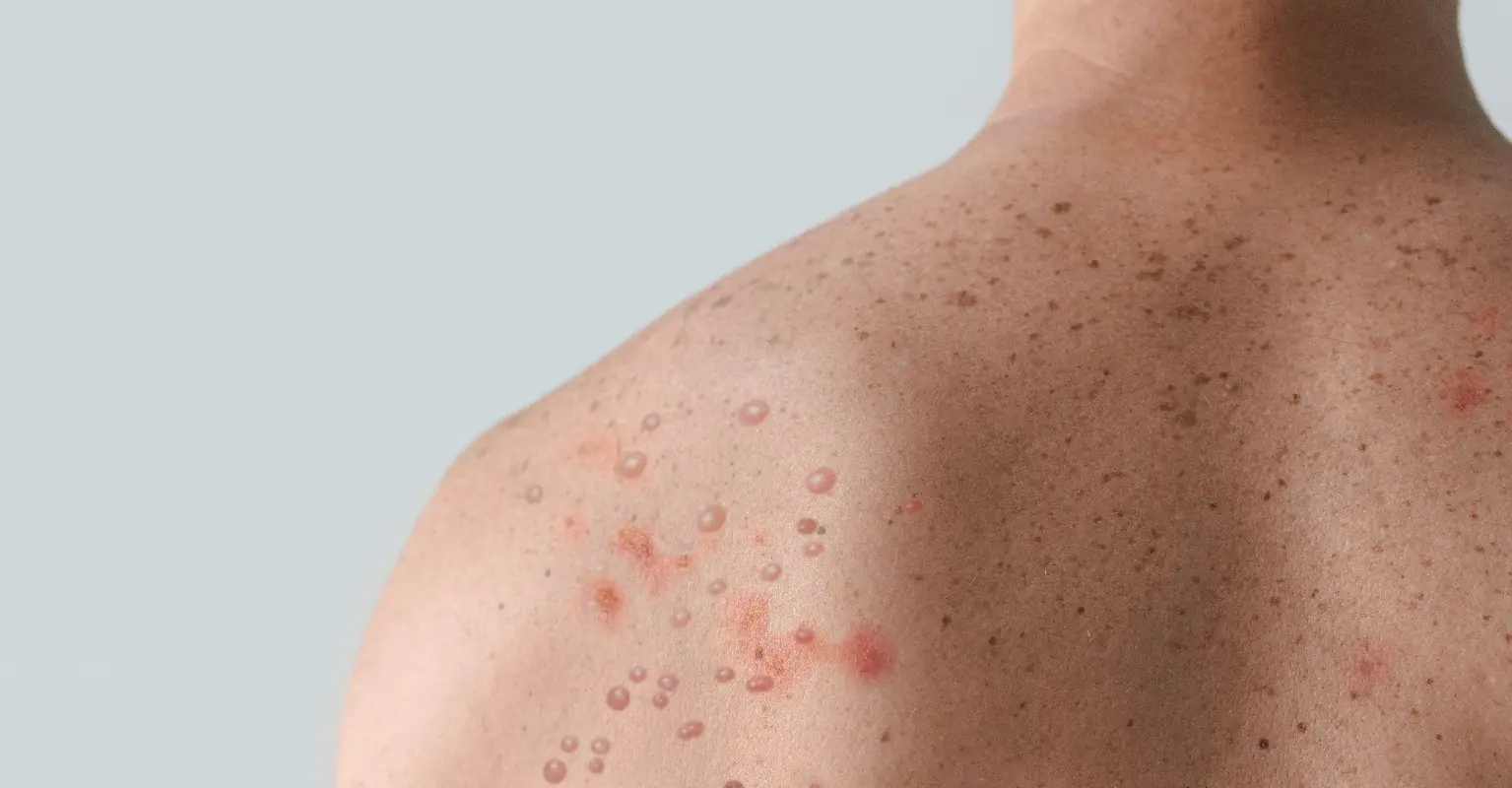 Monkeypox patient reveals how his lesions gradually worsened in daily selfies