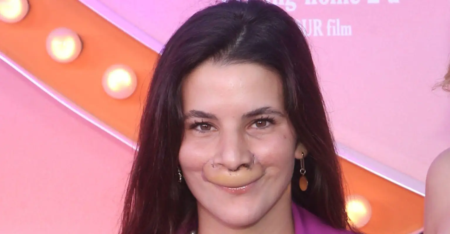 Model who had top lip ripped off by dog shows off incredible transformation