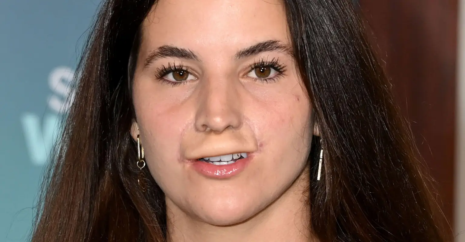 Model who had top lip ripped off by dog shows off final results of reconstruction surgery