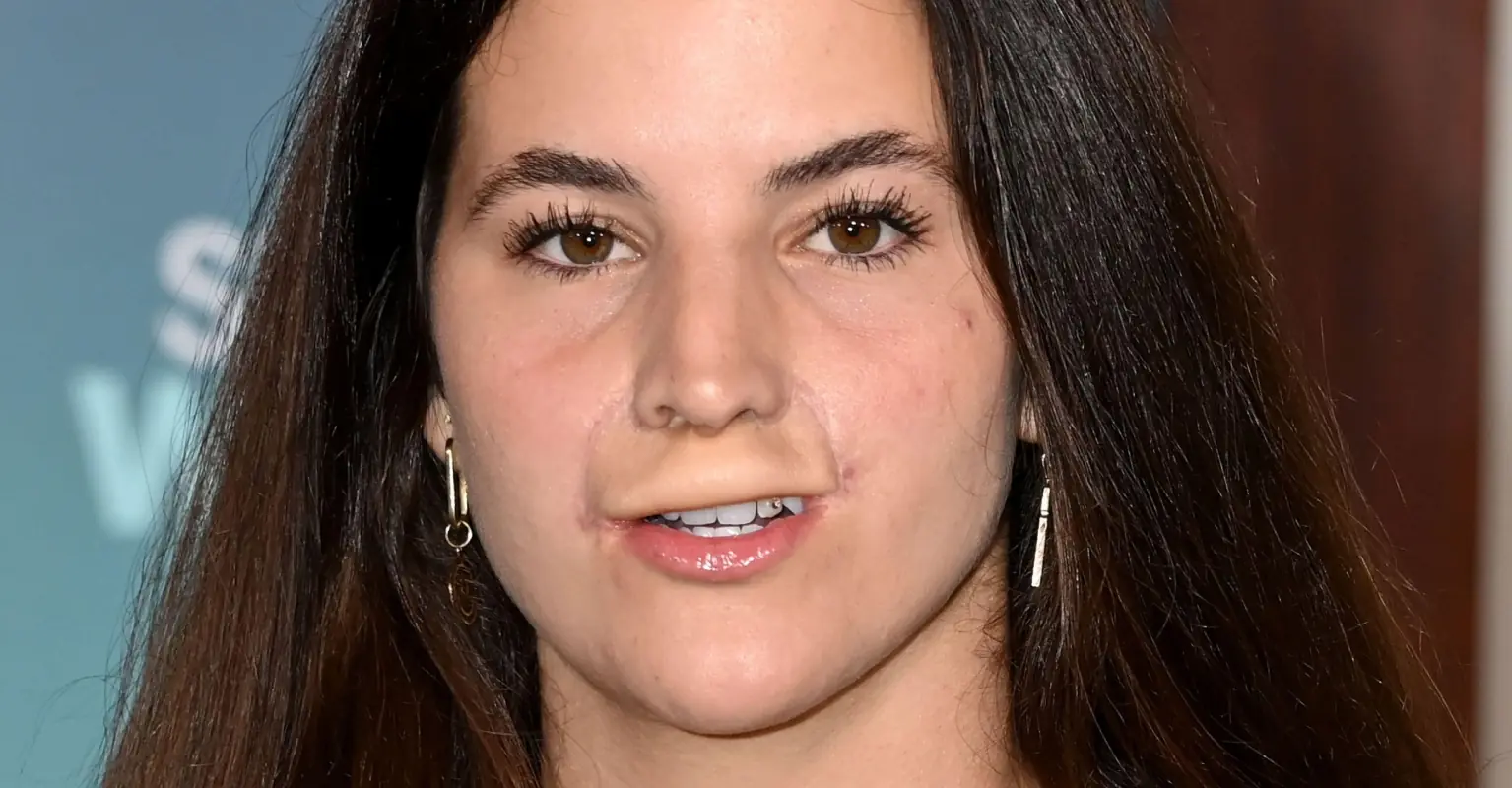 Model who had top lip ripped off by dog shows off final results of reconstruction surgery