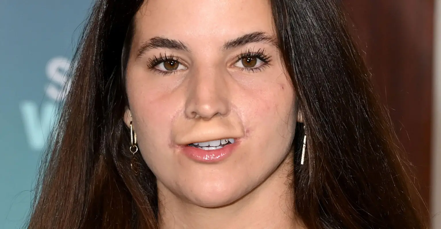 Skateboarder defends her doctors after trolls criticize reconstructive surgery after dog attack